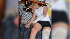 Menor de 14 años que fue golpeado por agentes policiales se encuentra postrado en una cama sin poder caminar