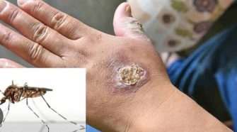 Casos de leishmaniasis