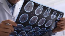 Alzheimer en el Perú