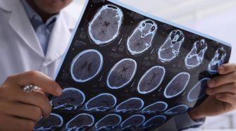 Alzheimer en el Perú