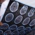 Alzheimer en el Perú