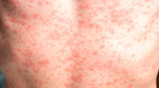 Alta contagiosidad y baja vacunación impulsan avance del sarampión