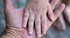 brote de virus Coxsackie
