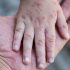 brote de virus Coxsackie