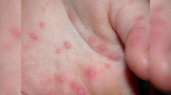 confirman 17 casos